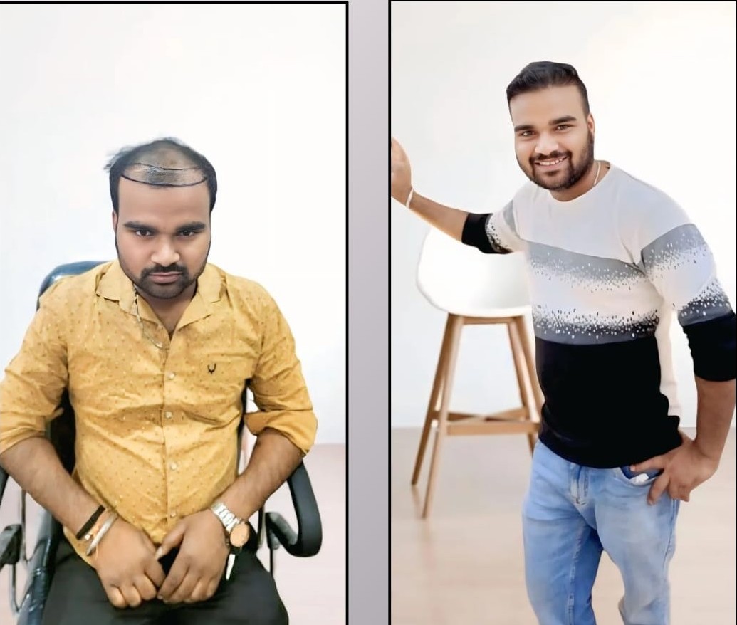 Before and After Hair Transplant