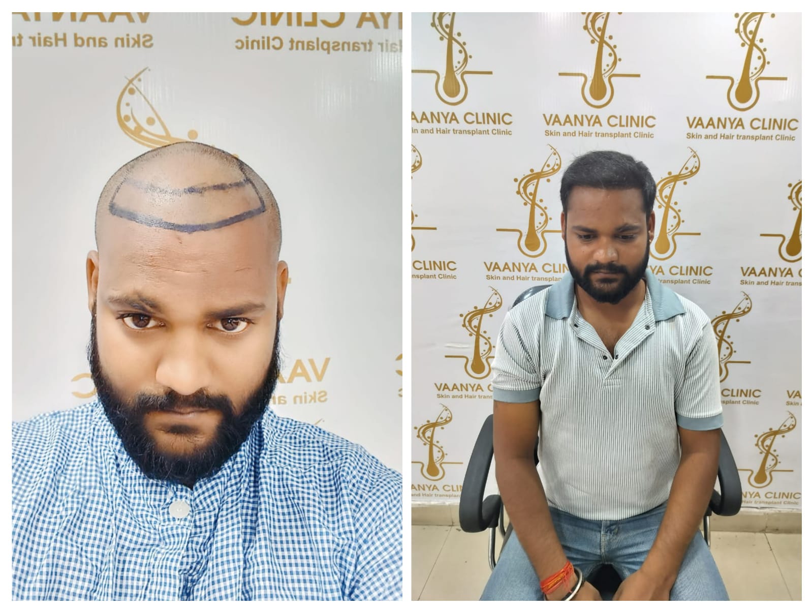 Before and After Hair Transplant
