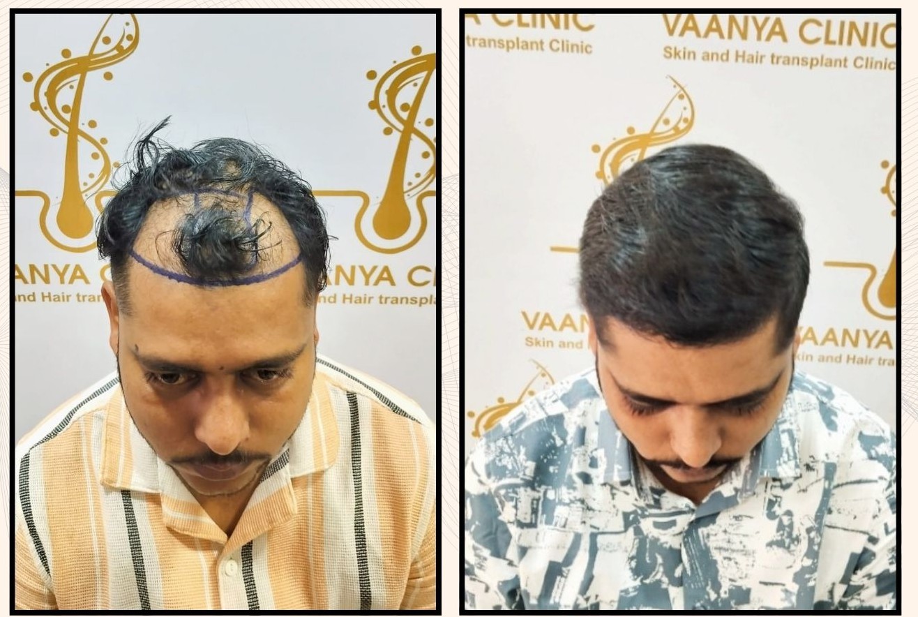 Hair Transplant Video